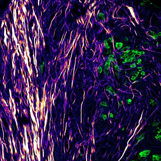 Green cells are melanoma cells, purple fibres are ECM_credit Oscar Maiques Carlos Human melanoma cells are seen in green escaping from the tumour, with surrounding ECM in purple, arranged perpendicular to the tumour