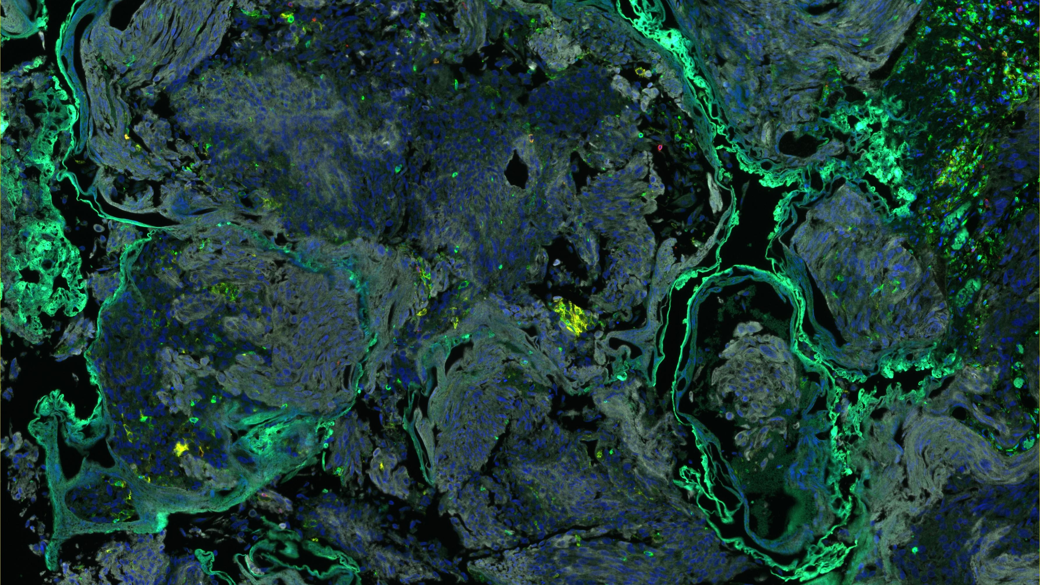 Islands - Immunofluorescence staining of bladder tumour tissue by Rose Foster_16x9 Image of immunofluorescence staining of bladder tumour tissue. Some areas appear lighter green, some dark blue, and others black.