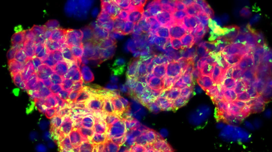 metastatic neuroblastoma cells Picture of metastatic neuroblastoma cells under a microscope