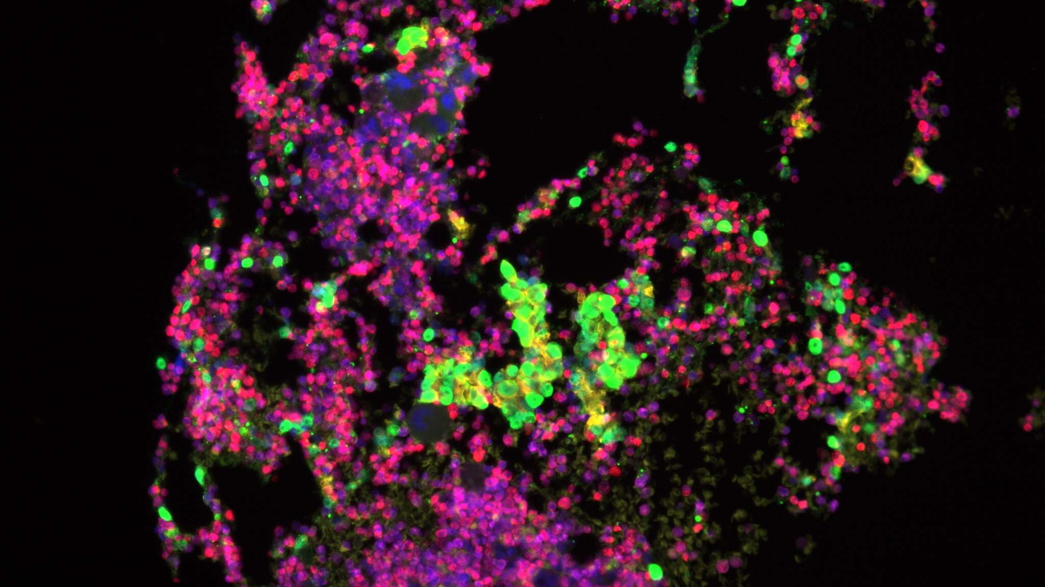 prostatecancer An image of prostate cancer cells taken using an automated fluorescence scanning system