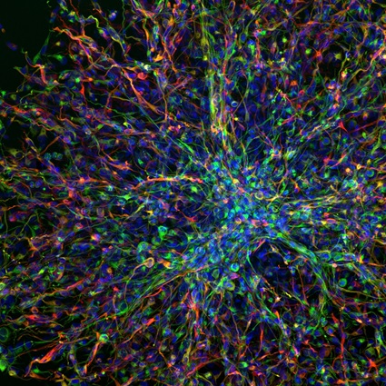 human paediatric brain tumour derived cells - chris jones Microscope image of cells from a human brain tumour