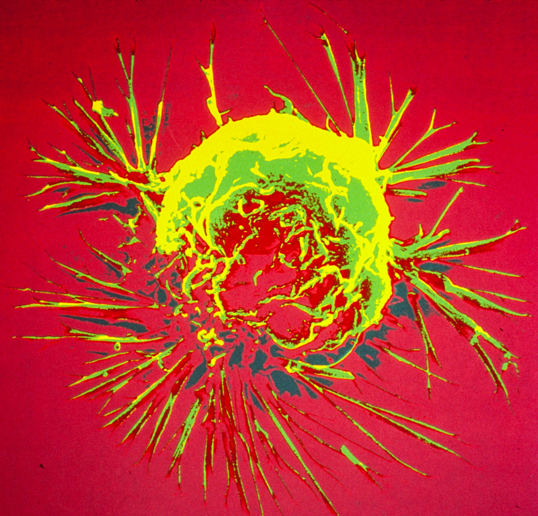 Breast cancer cell