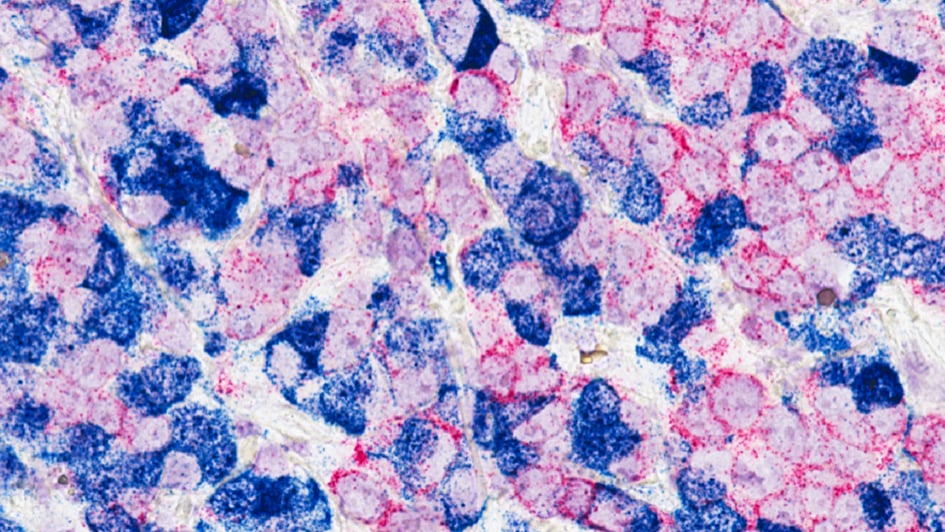 Breast Cancer Cells Credit Min Yu 945x532