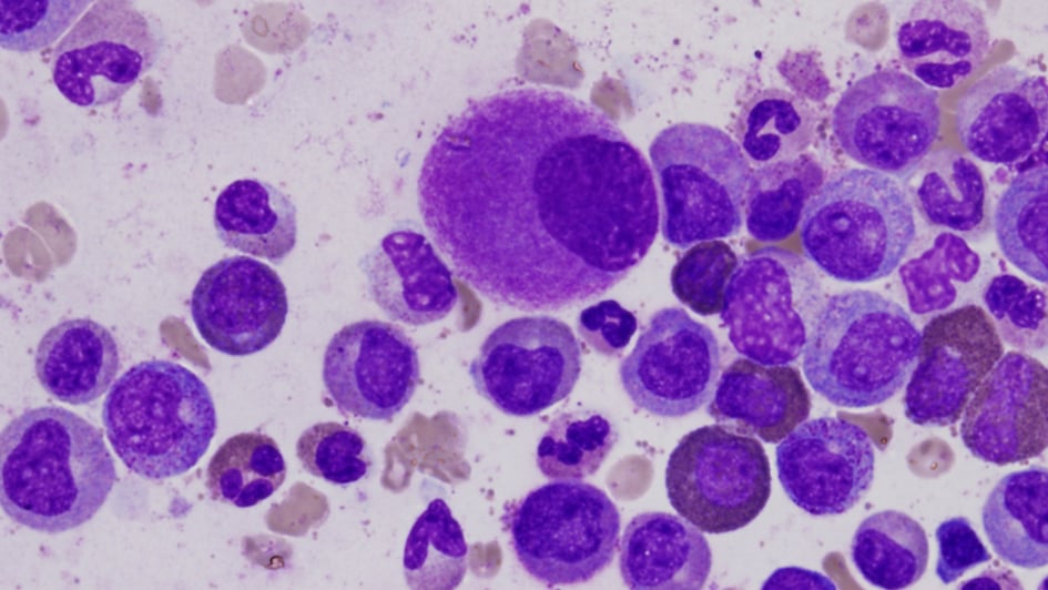 Deformed cells in the bone marrow, typical of chronic leukaemia Deformed cells in the bone marrow, typical of chronic leukaemia