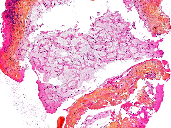 Intermediate magnification micrograph of a chordoma. HPS stain - 547x410 Intermediate magnification micrograph of a chordoma. HPS stain