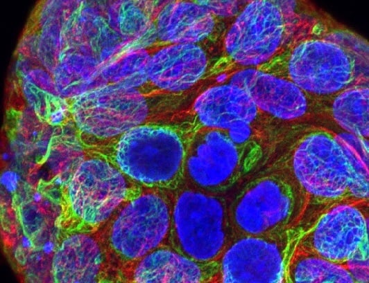 KRAS mutant cells 547x410 KRAS-mutated colorectal cancer cells