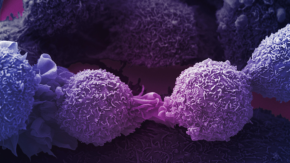Lung cancer cells purple 945x532px Purple lung cancer cells