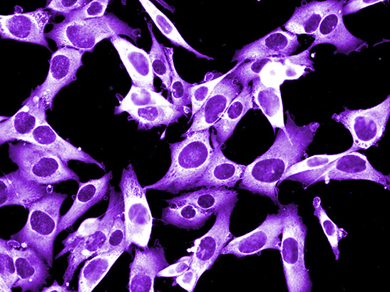 melanoma-cancer-cells-embed-547x410 Melanoma cancer cells (photo: istockphoto.com/Plinio R Hurtado/Dlumen)