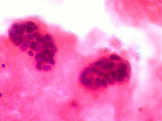 Metastatic Breast Cancer in Pleural Fluid 547x410 Metastatic breast cancer cells in pleural fluid