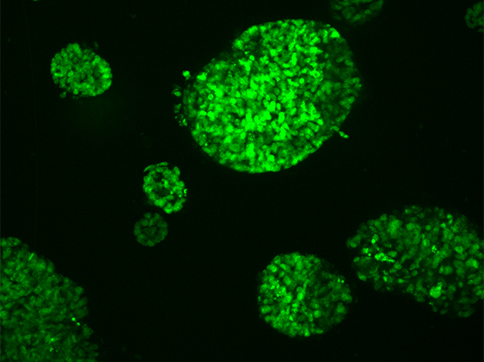 Mini tumours grown from a bowel cancer 547x410px