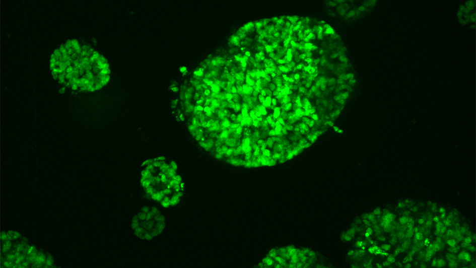 Mini tumours grown from a bowel cancer 945x532px Mini tumours grown from a bowel cancer