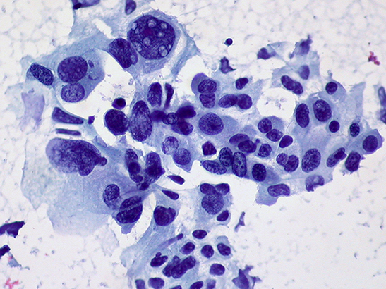 Non-small cell lung cancer (photo Dr Ed Uthman-Yale Rosen-Flickr)