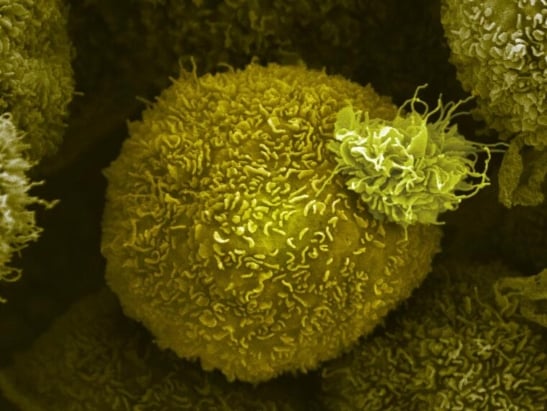 pancreatic cancer cell 547x410 pancreatic cancer cell