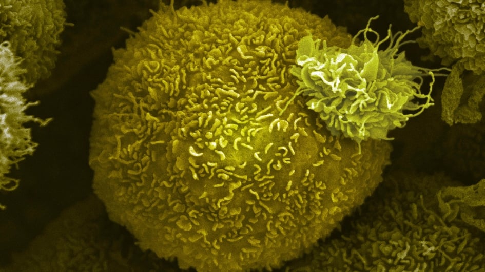 pancreatic cancer cell