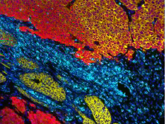 Prostate cancer cells