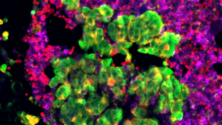 Prostate cancer cells 874x492 Prostate cancer cells (Mateus Crespo/Prof Johann de Bono, the ICR)