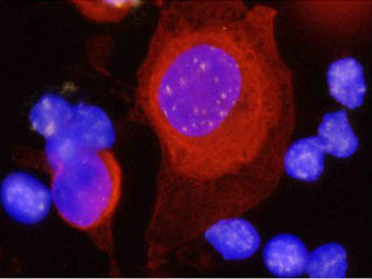 prostate-cancer-ctcs Prostate cancer circulating tumour cells