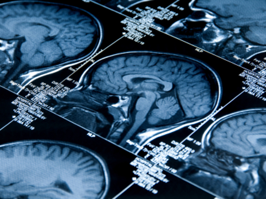 MRI Brain Scan MRI Brain Scan