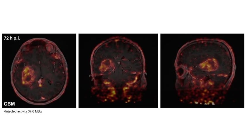 neurooncology-pet-images PET scans of a glioblastoma patient's brain, 72 hours after injection with the radiotracer.